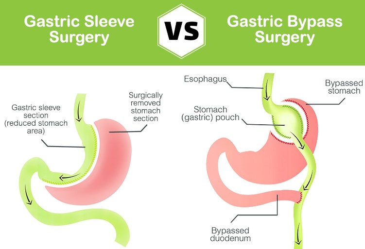 Gastric Sleeve or Gastric Bypass