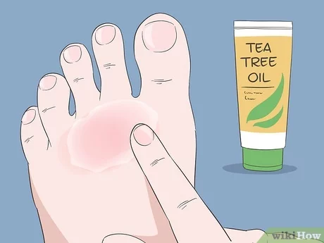 Home Remedies for Athletes foot