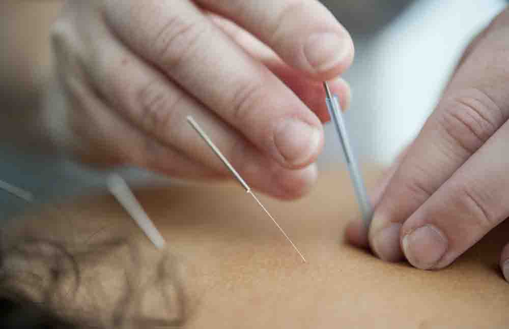 A person undergoing the acupuncture process