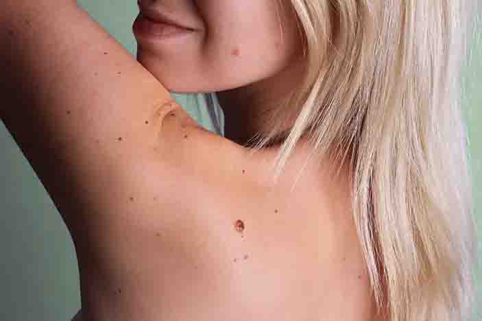 Does a Mole Turn into Skin Cancer?