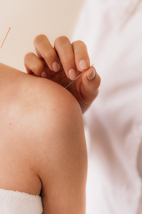 Acupuncturist pinning needle on a woman’s shoulder