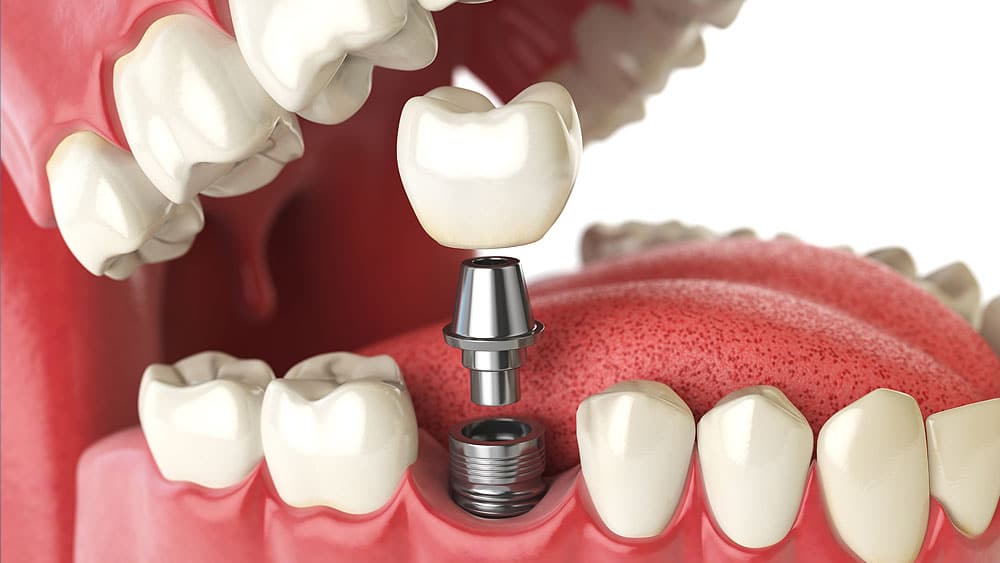 A Detailed Guide on Dental Implants