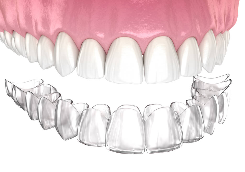 Get the Perfect Smile with Invisalign Orthodontics