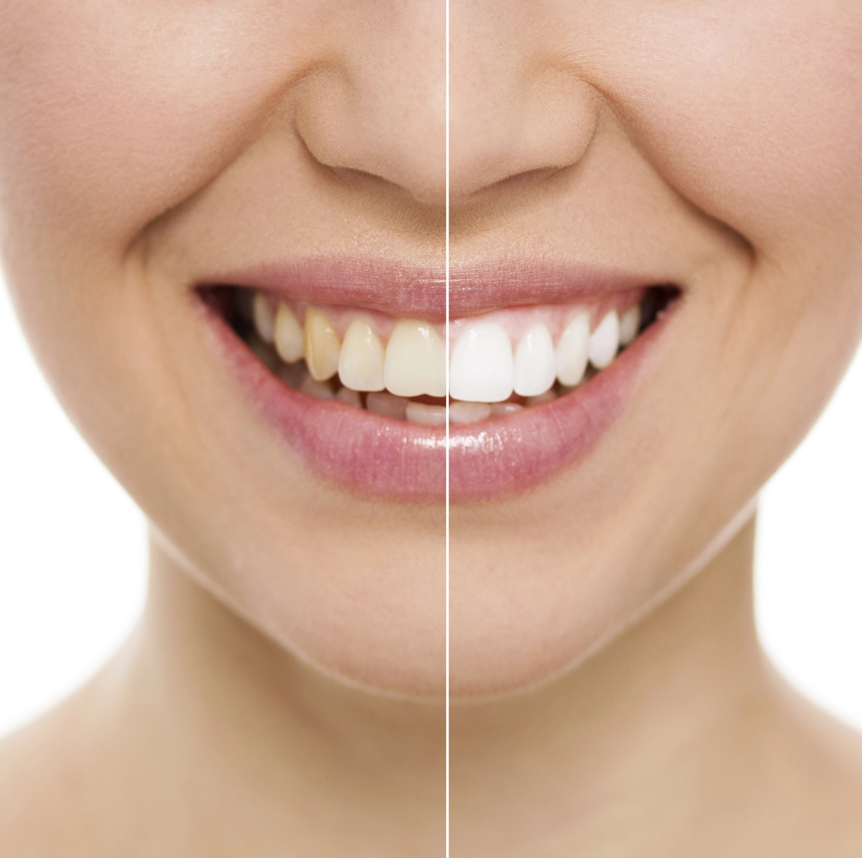 Composite Bonding: A Quick and Easy Solution for Enhancing Your Smile