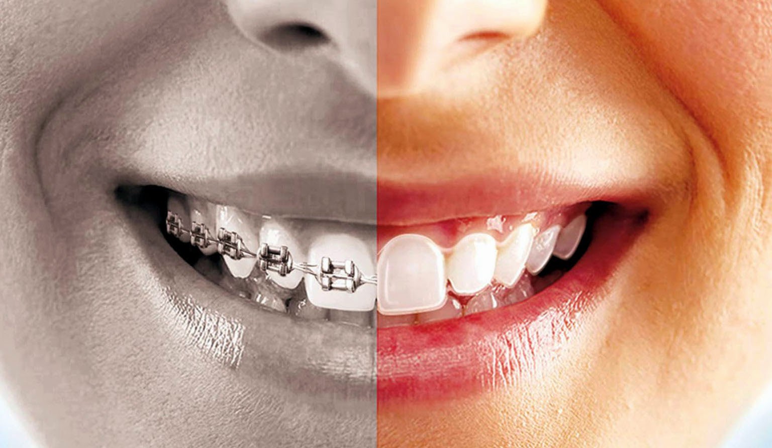 Straightening Your Teeth the Invisible Way: Clear Aligners Explained