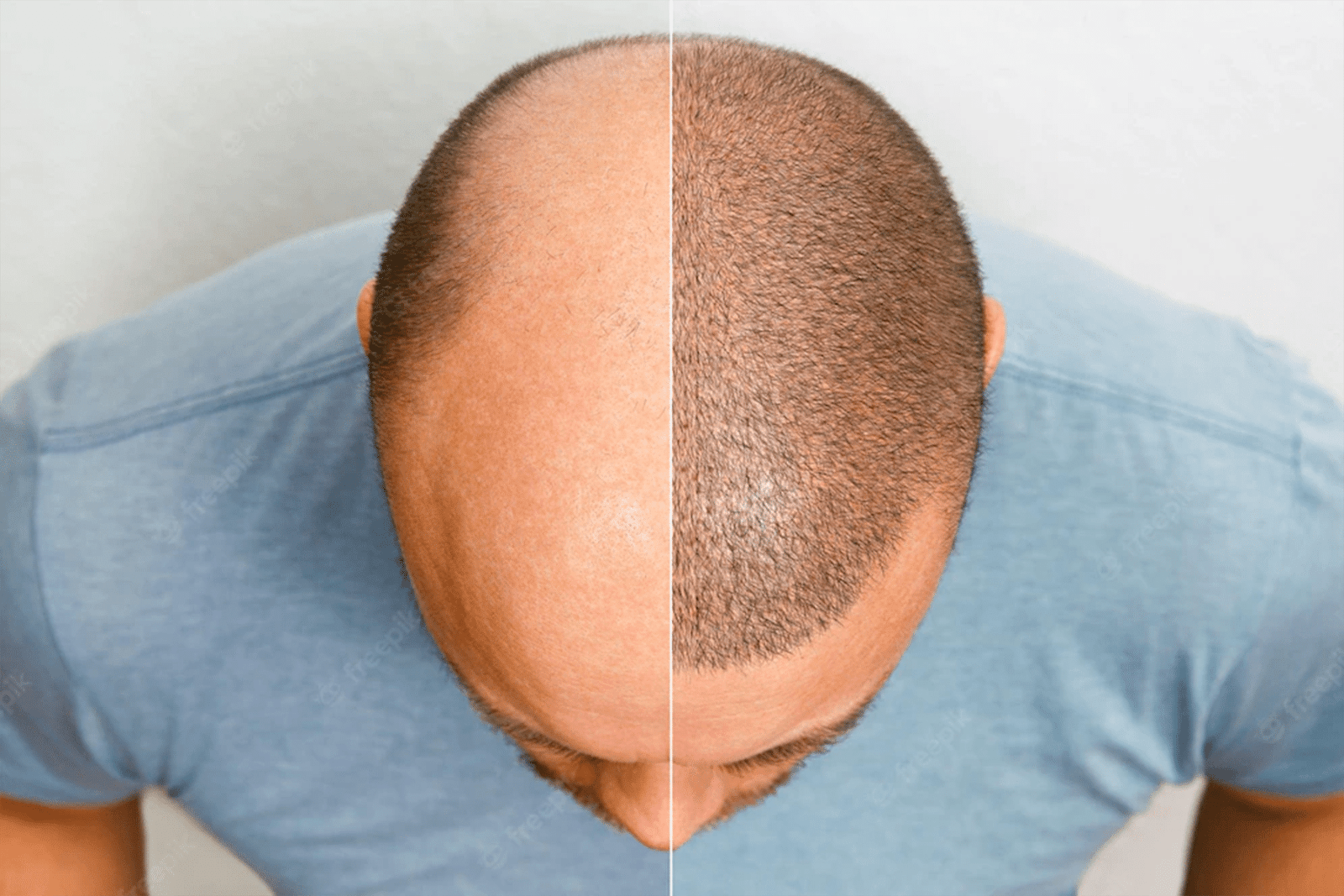Choosing Your Path: Invasive vs. Non-Invasive Hair Transplants