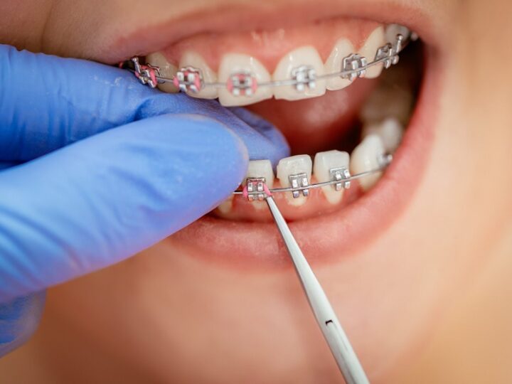 Cost Comparison: Dental Procedures in Turkey vs. United Kingdom