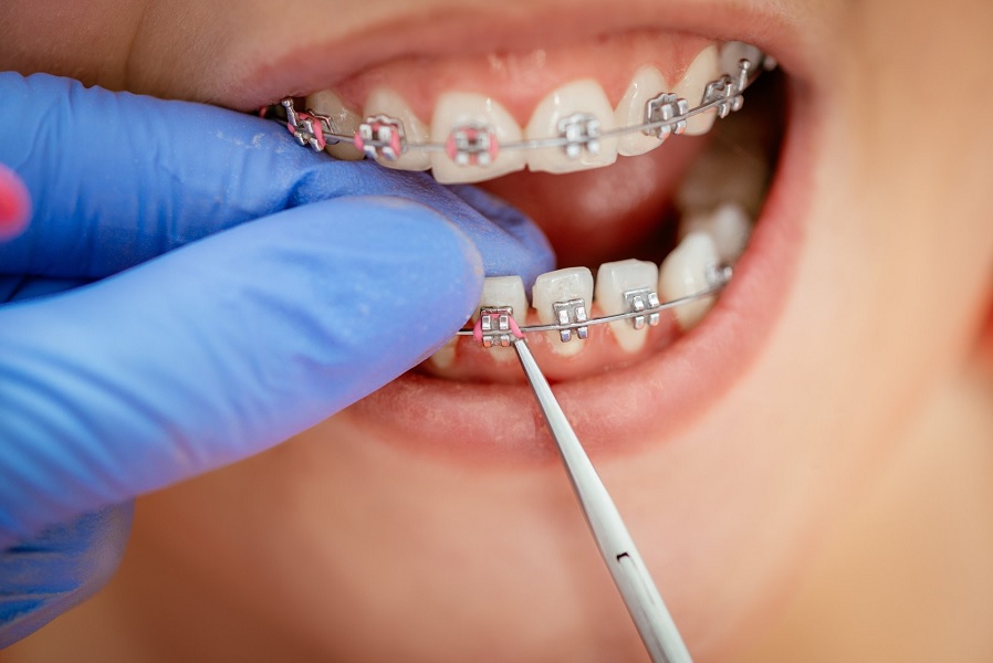 Cost Comparison: Dental Procedures in Turkey vs. United Kingdom