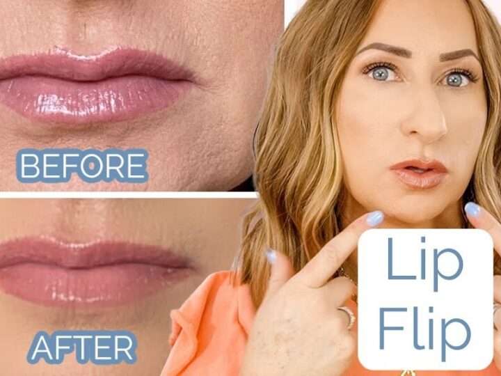 Lip Flip Before and After: What to Expect & Real Transformations