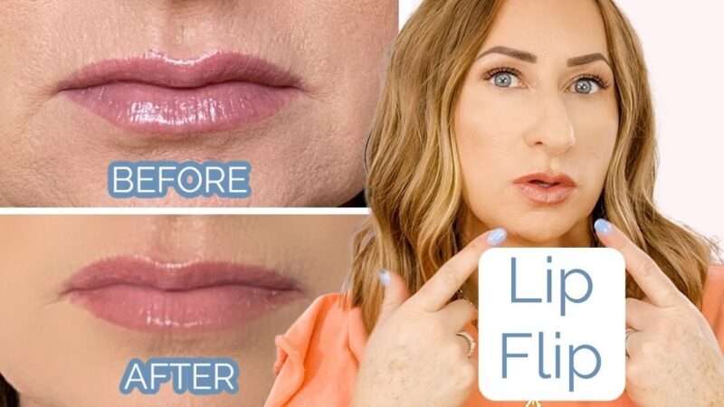 Lip Flip Before and After: What to Expect & Real Transformations