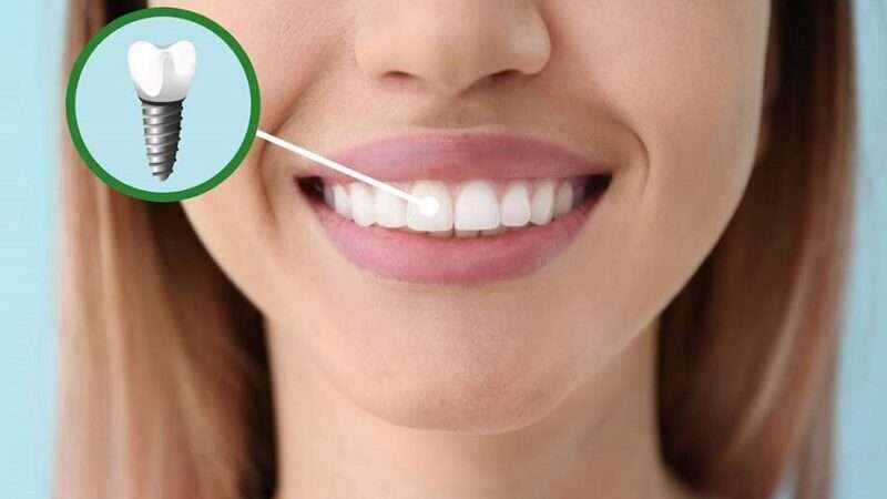 What is a Guided Dental Implantation and What are its Main Advantages?