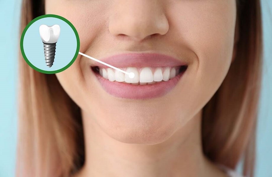 What is a Guided Dental Implantation and What are its Main Advantages?